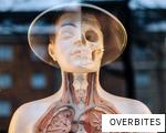 OVERBITES anagram